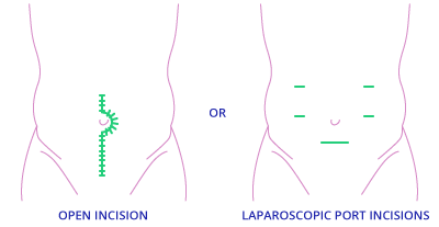 Low Anterior Resection LAR Diagram with Temporary Ileostomy for TAMIS Surgery